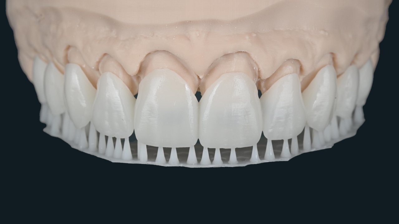 A full arch of printed temporaries on a model, still attached to their print supports