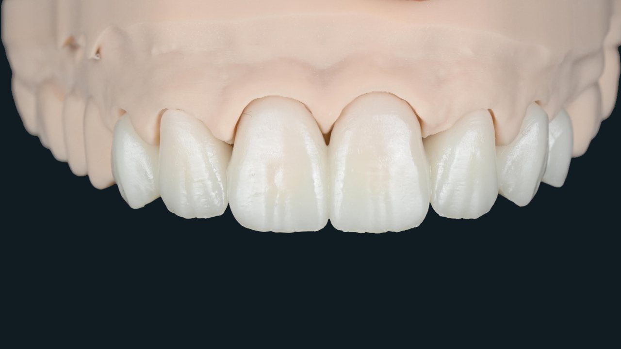 Upper anterior temporaries with visible surface texture on a gum-colored model