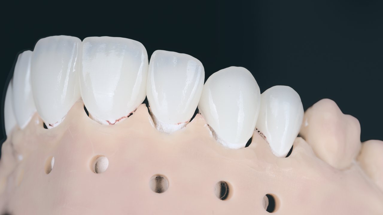 Upper veneers on a working model seen from the side, showing translucent incisal edges