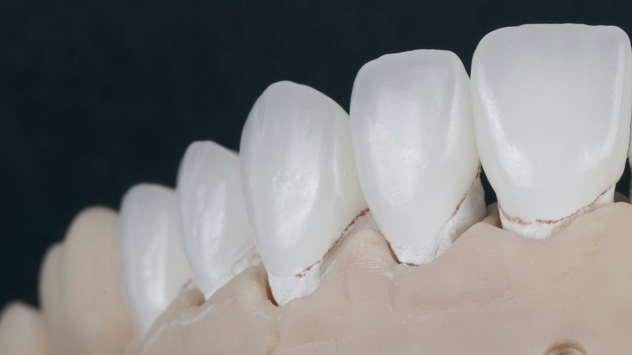 Close-up of veneers on the working model with red finish-line markings at the margins