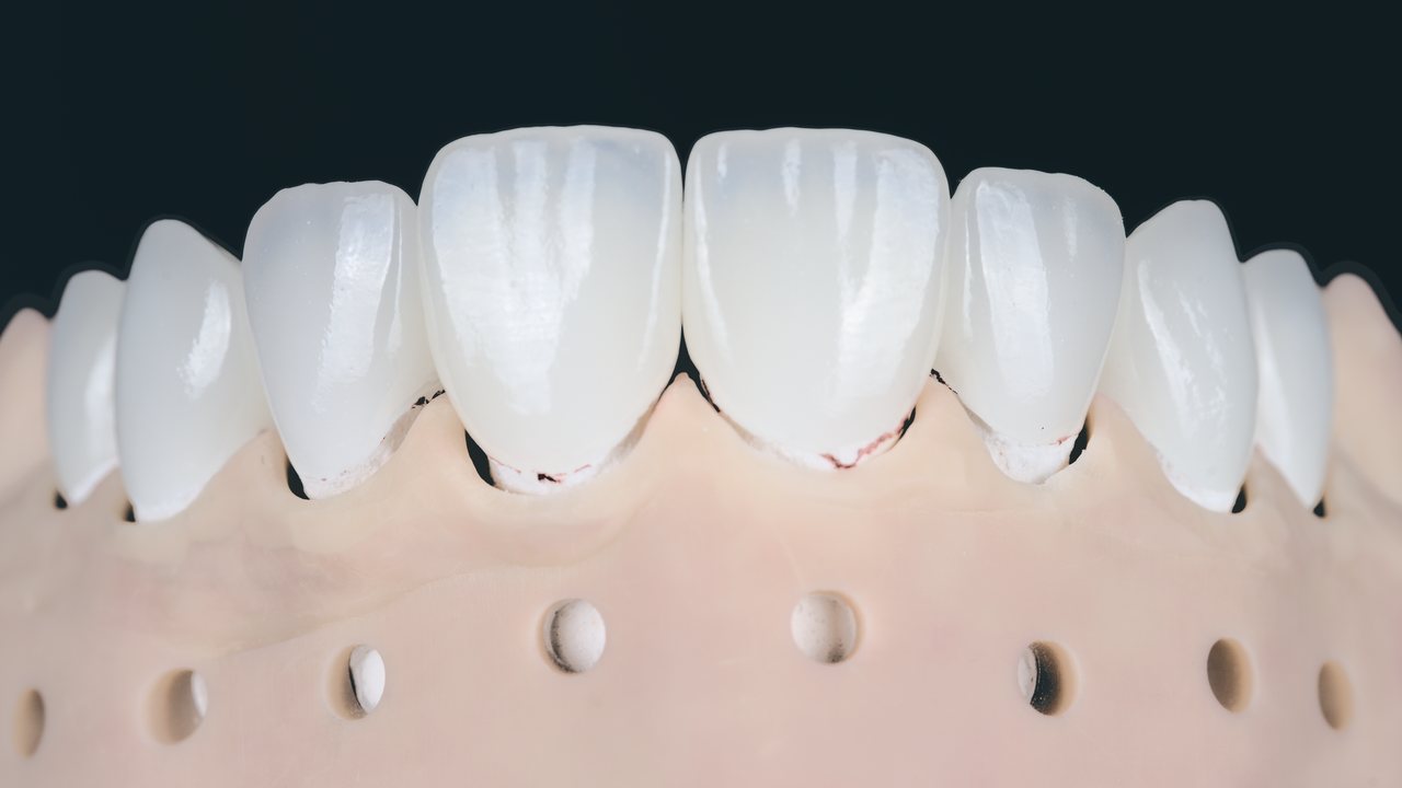 A full set of upper anterior veneers seated on a stone working model, front view